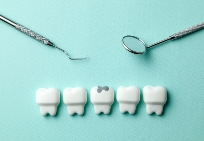 虫歯の歯の模型