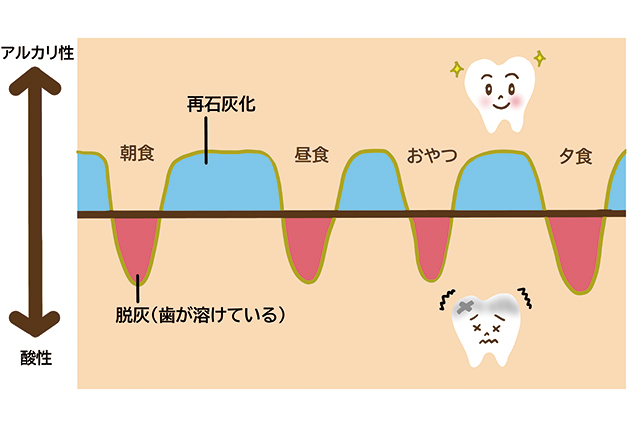 虫歯になるメカニズム