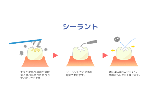 シーラント