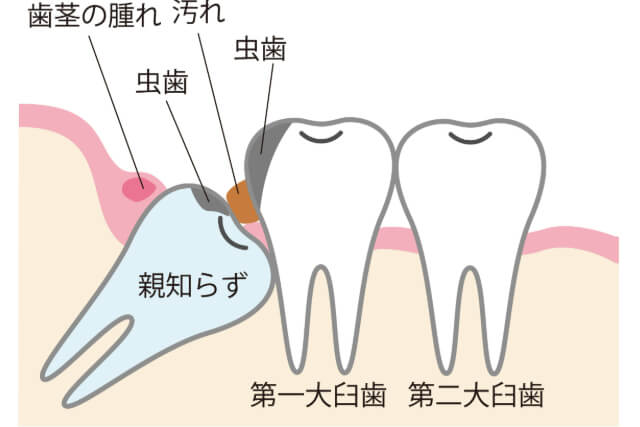 親知らずで起きやすい症状（なぜトラブルが多いのか）