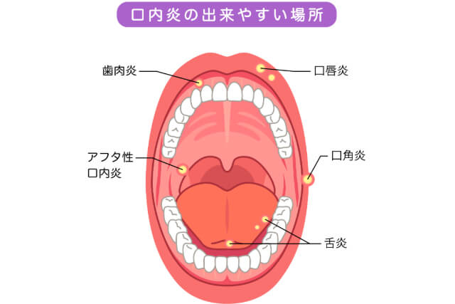 口内炎などのお口に関するできもの